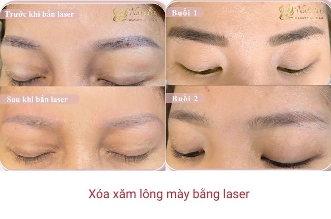 xoa-xam-long-may-bang-laser