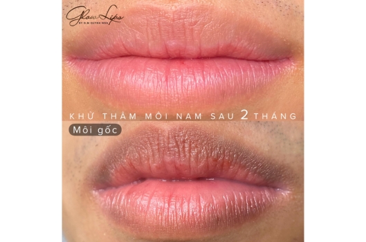 khu-tham-moi-co-bi-tham-lai-khong-2