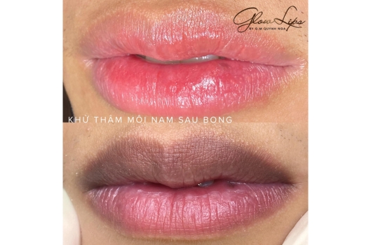 khu-tham-moi-co-bi-tham-lai-khong