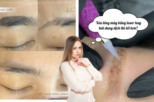 xoa-long-may-bang-dung-dich-hay-laser