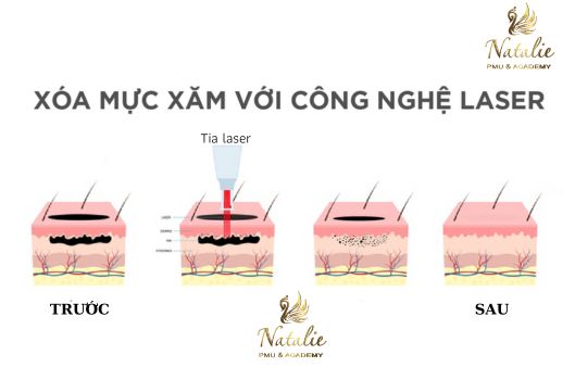 co-nen-hut-muc-moi-bang-laser-2