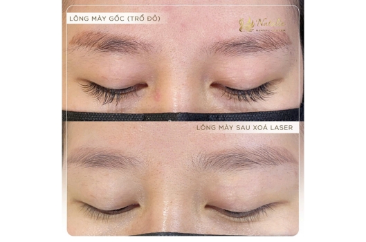 xoa-may-tro-o-tai-natalie